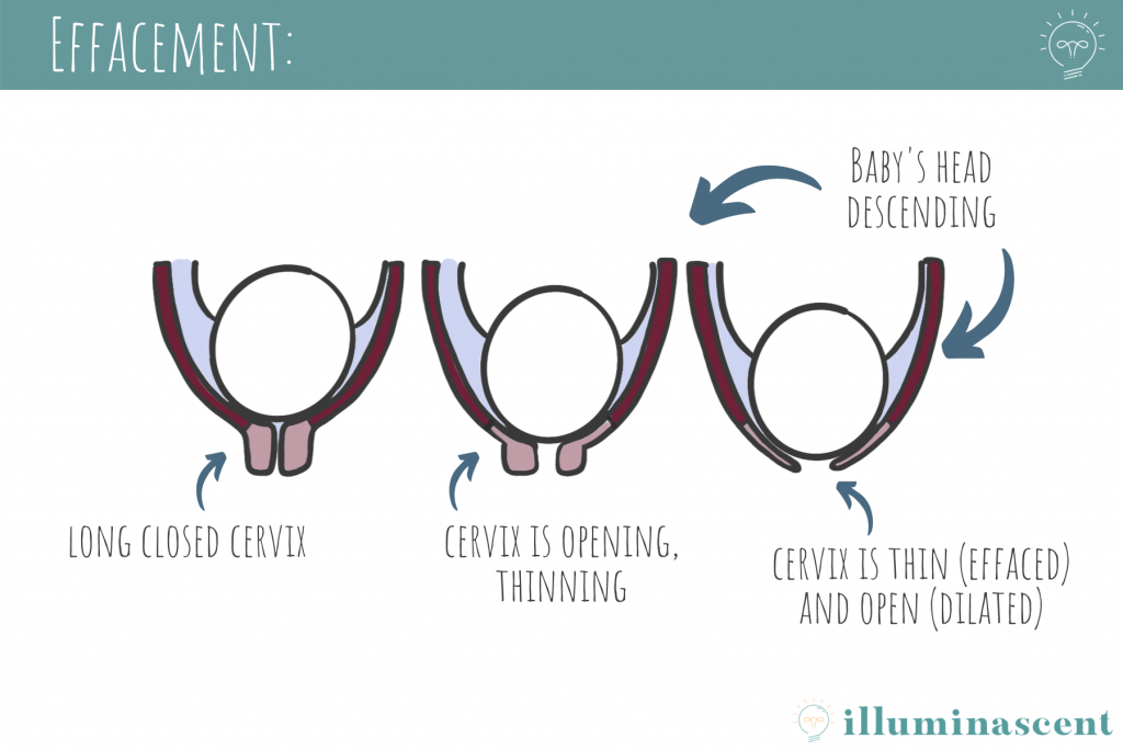 effacement and dilation