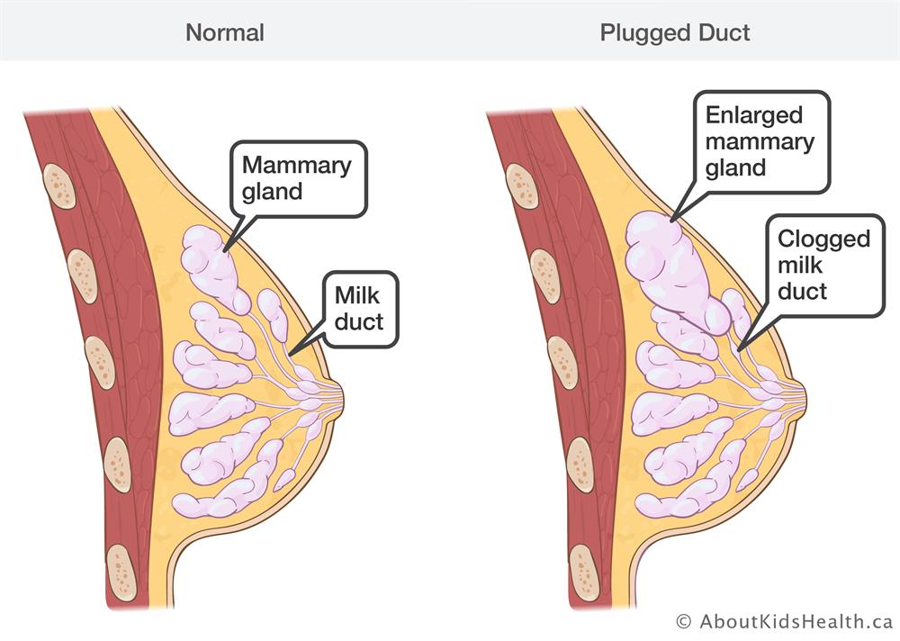 The best way to clear a plugged milk duct 1 BreastAna PluggedDuct EN BreastAna PluggedDuct EN